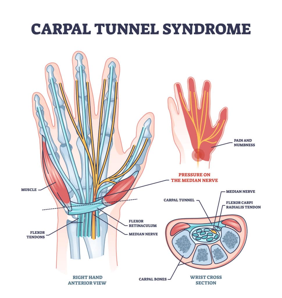 diagram of carpal tunnel syndrome
