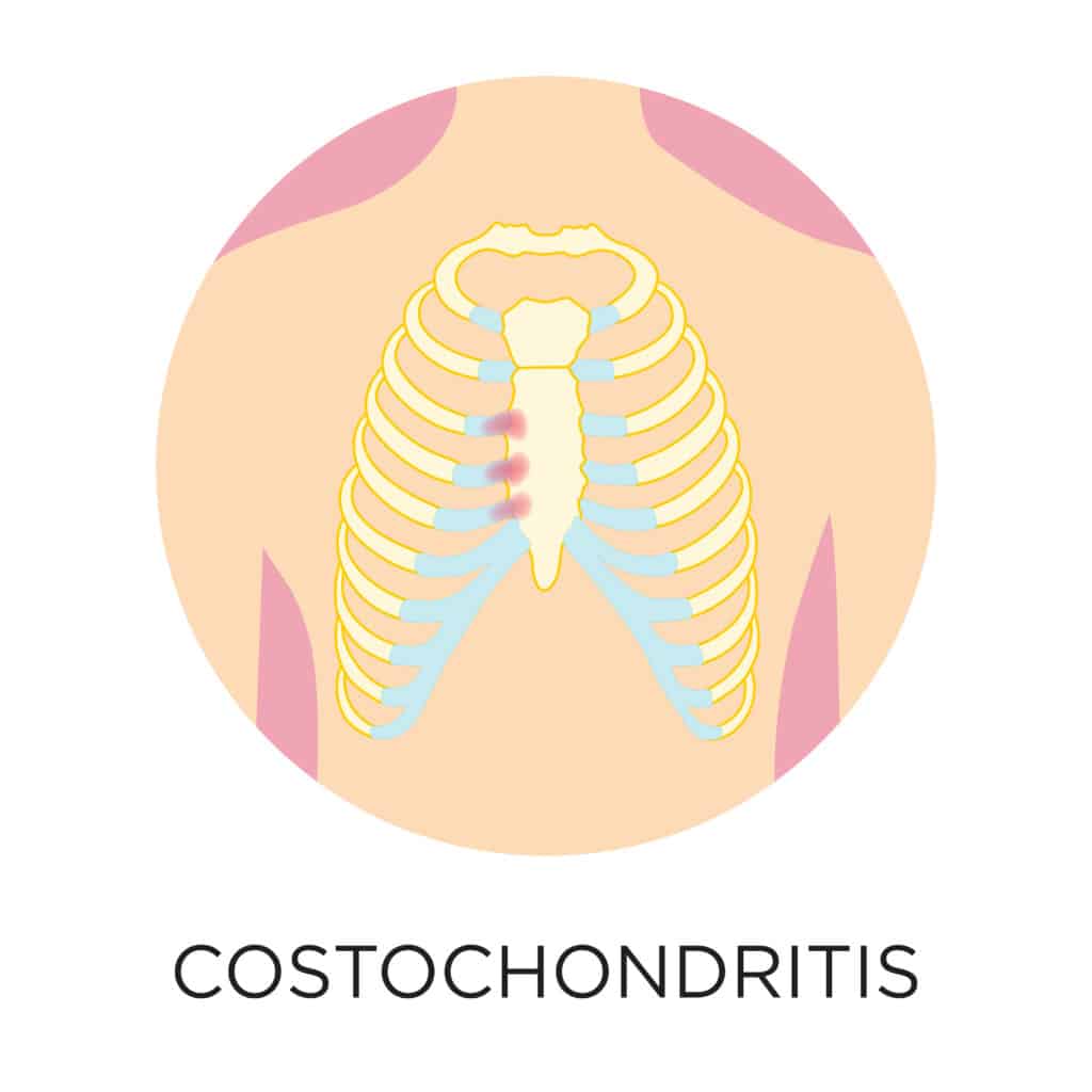 diagram of costochondritis