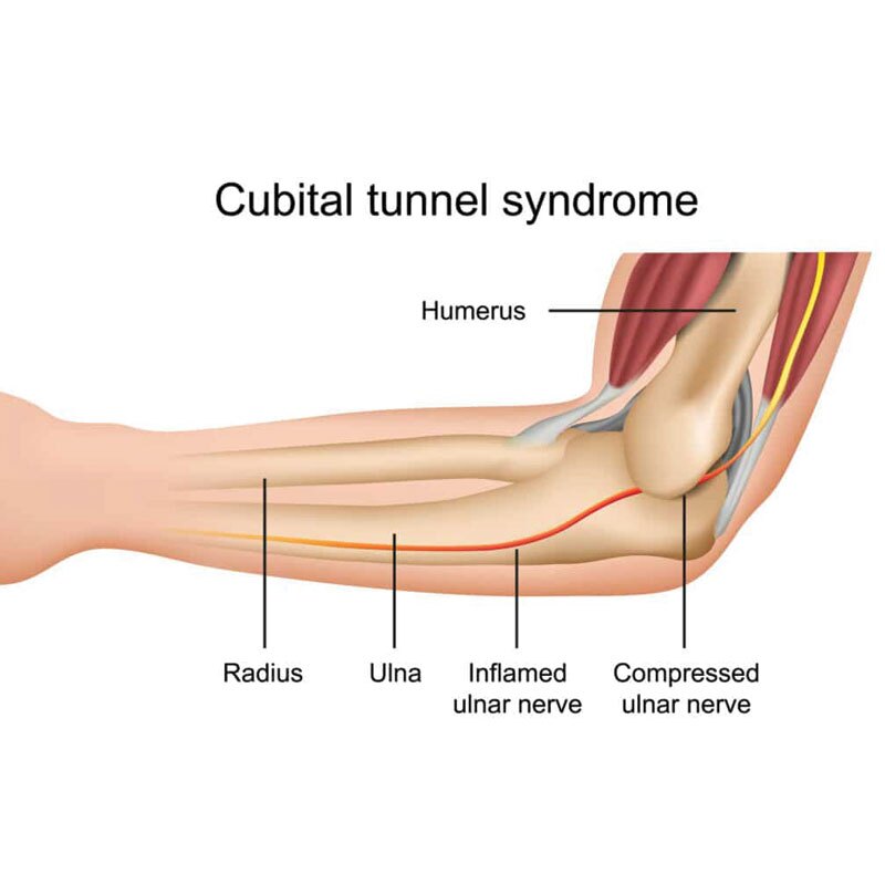 diagram of cubital tunnel syndrome