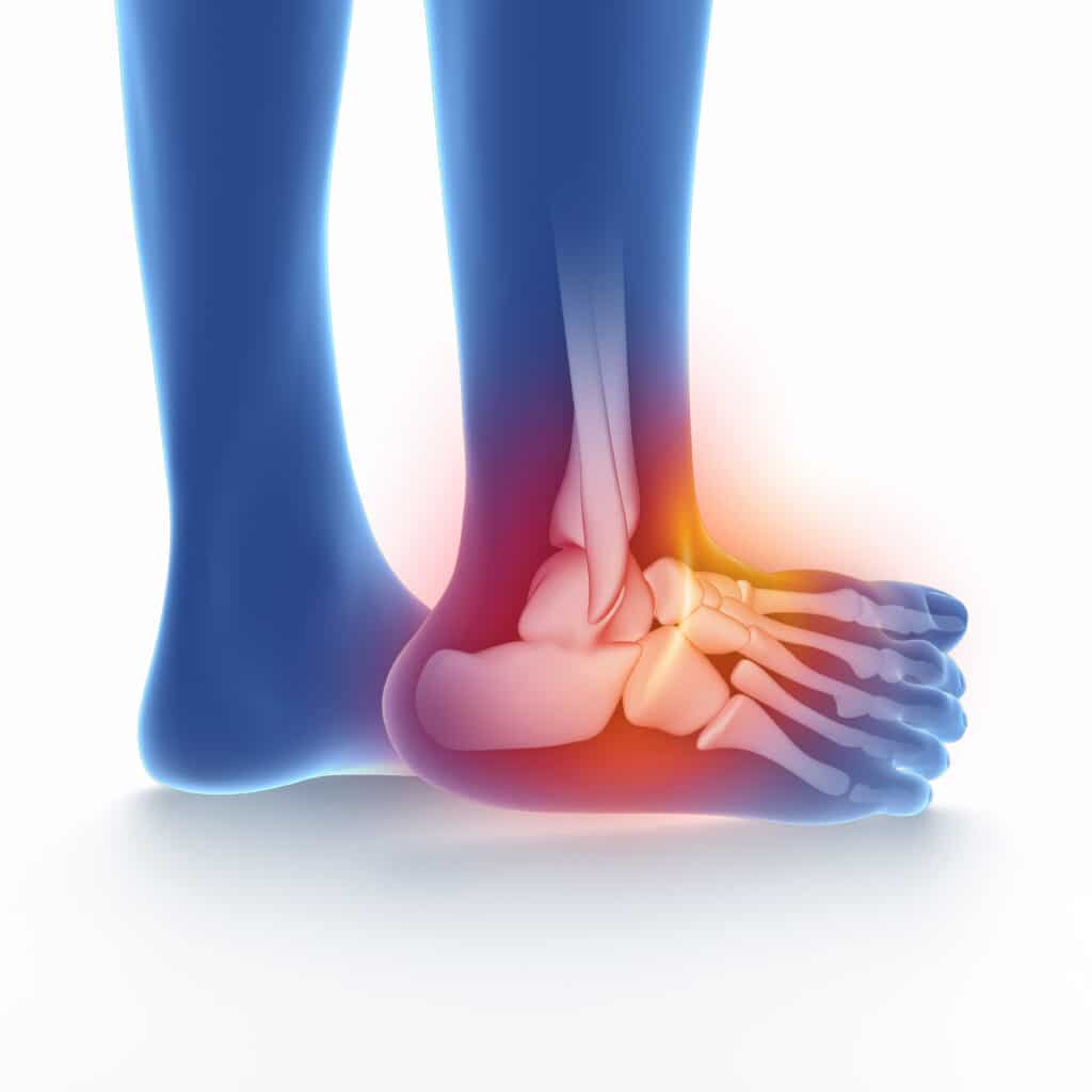 graphic showing deltoid ligament sprain