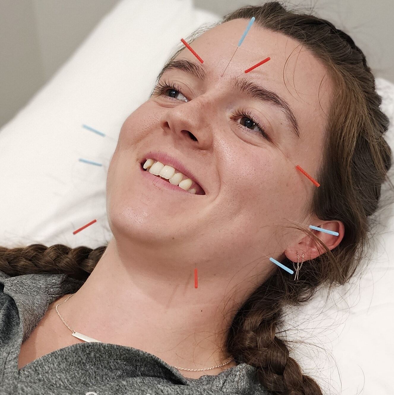 facial accupuncture practitioners - Facial Acupuncture