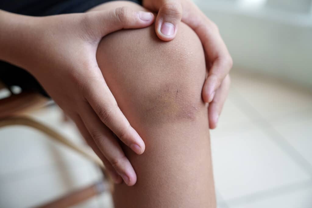 Do Contusions Hurt All the Time?