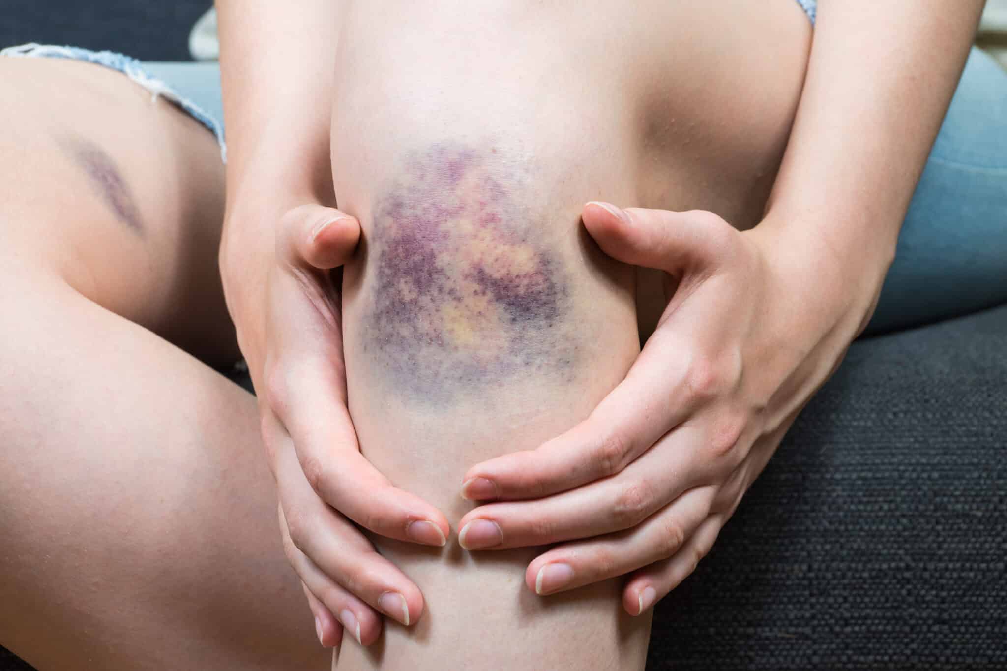 Do Contusions Hurt More at Night?