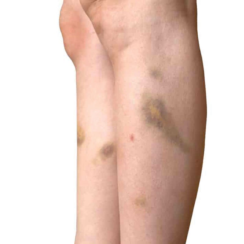 contusions on legs