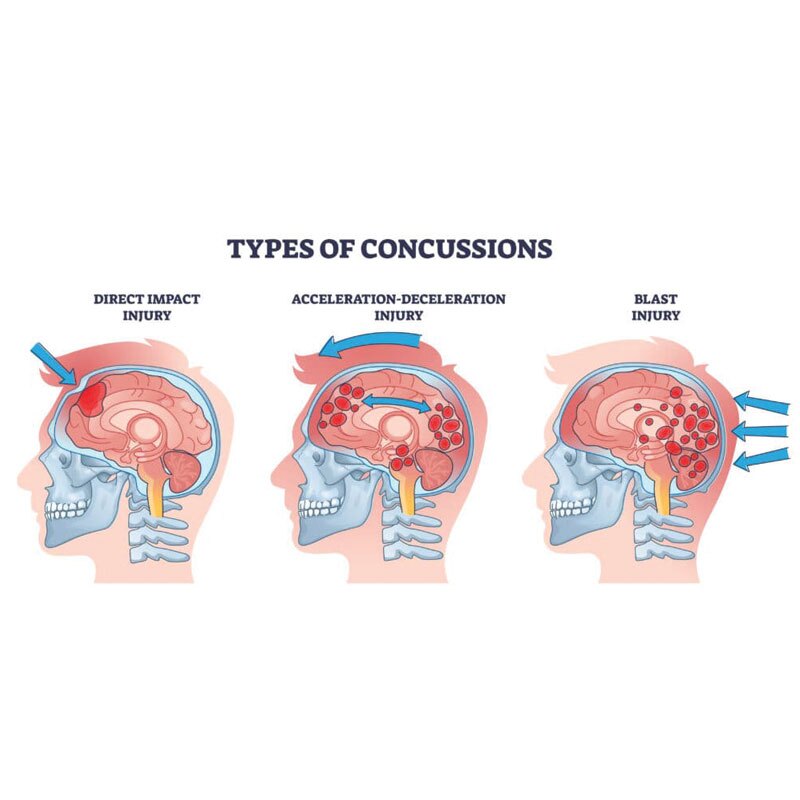 types of concussions