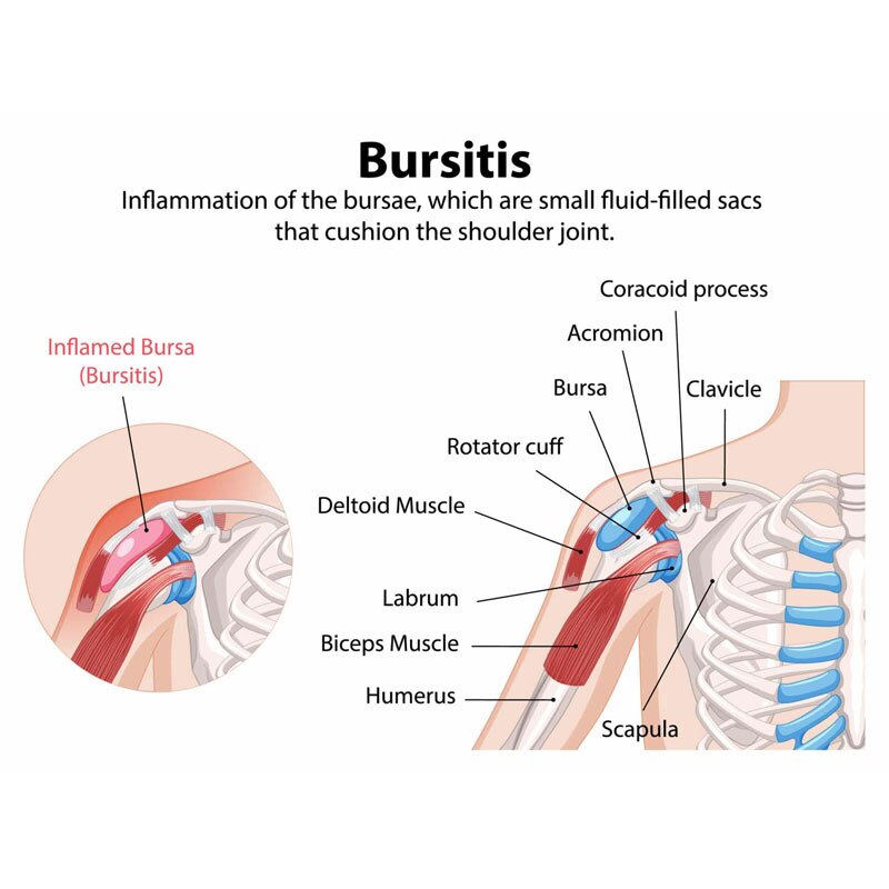 diagram of shoulder bursitis
