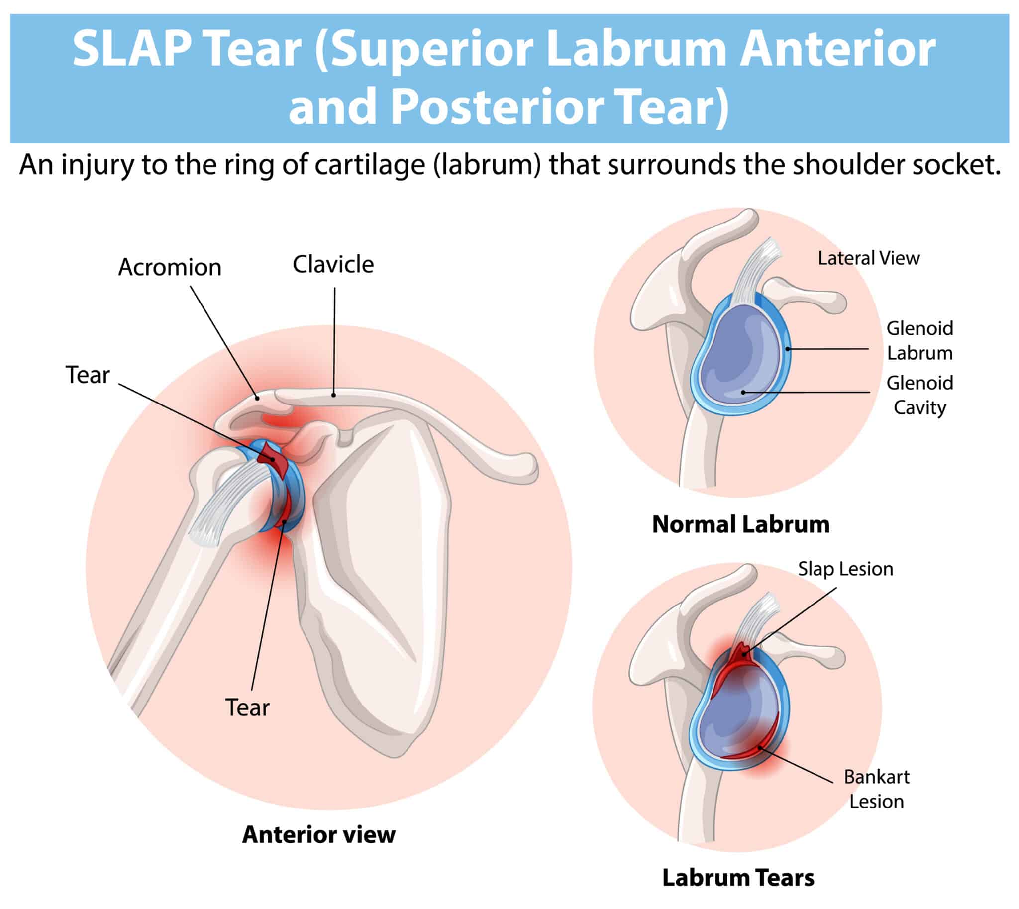 diagram of shoulder slap lesion