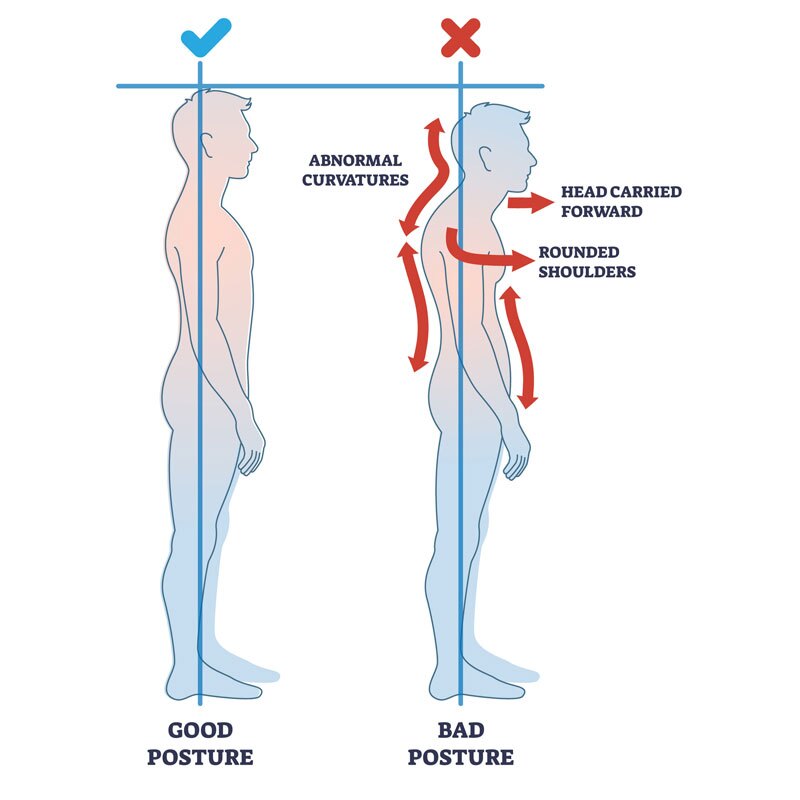 diagram of upper cross postural imbalance