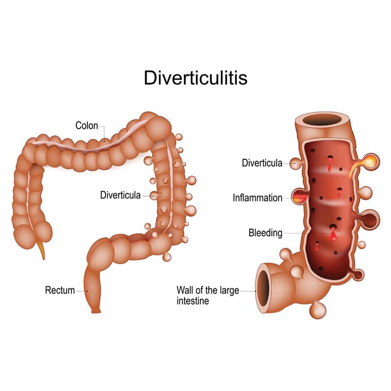 anatomical diagram of diverticulitis