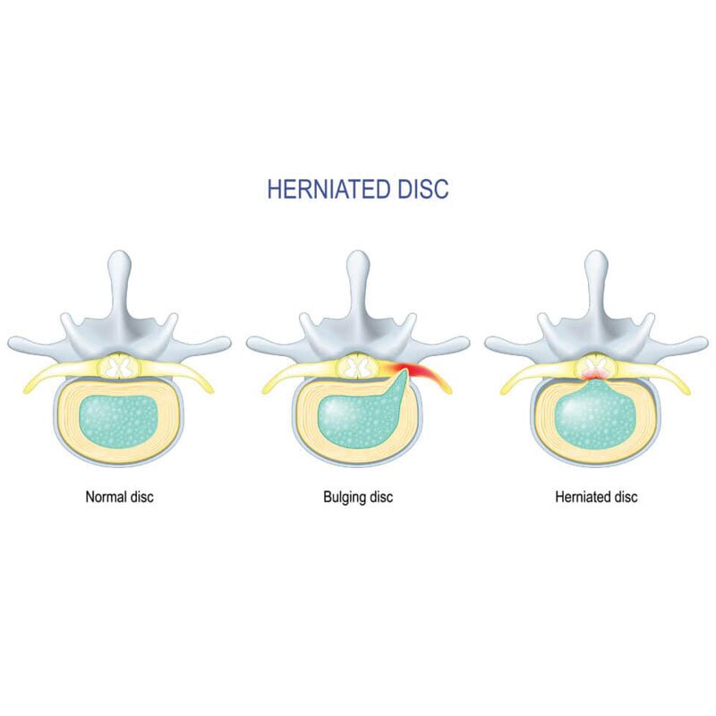 diagram showing herniated discs