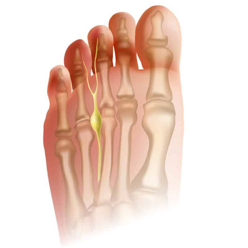 diagram of morton's neuroma