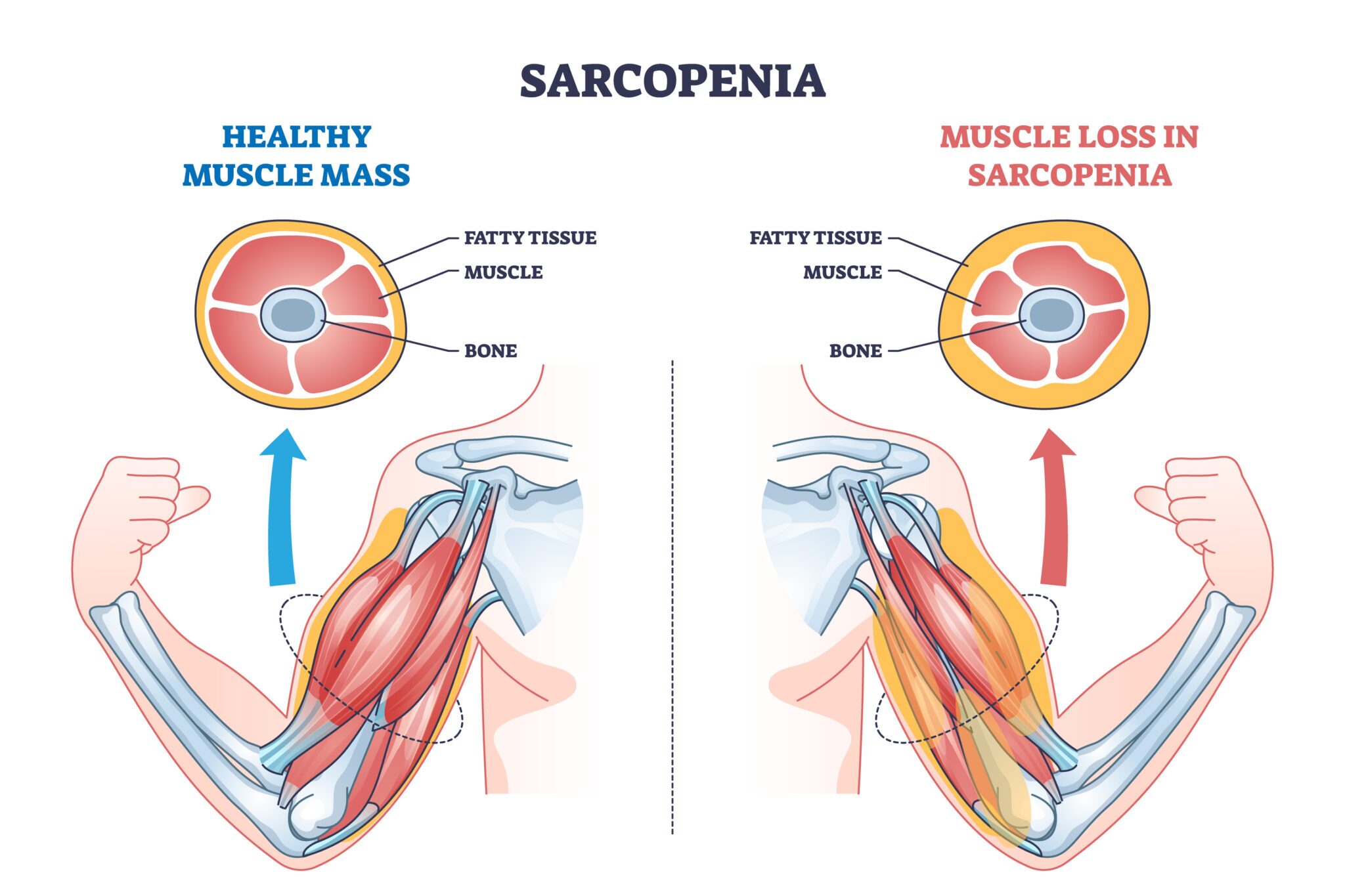 diagram of sarcopenia