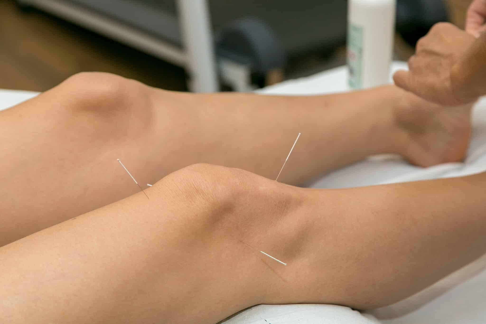 acupuncture treatment kitchener waterloo scaled