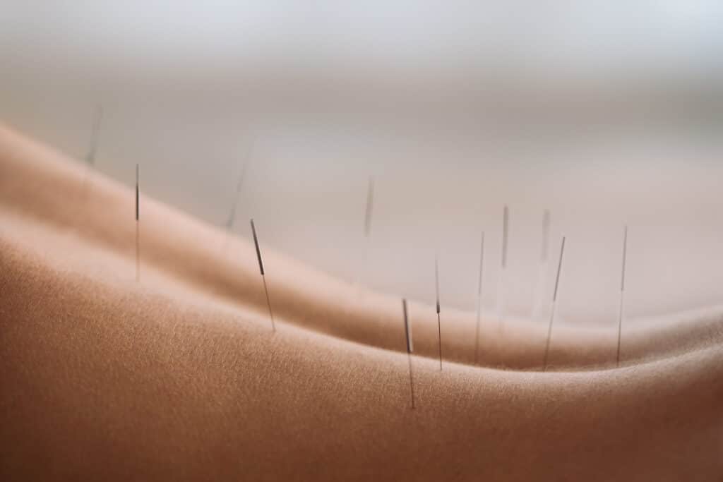 acupunture kitchener waterloo ontario - What Evidence-Based Acupuncture Can Do for You