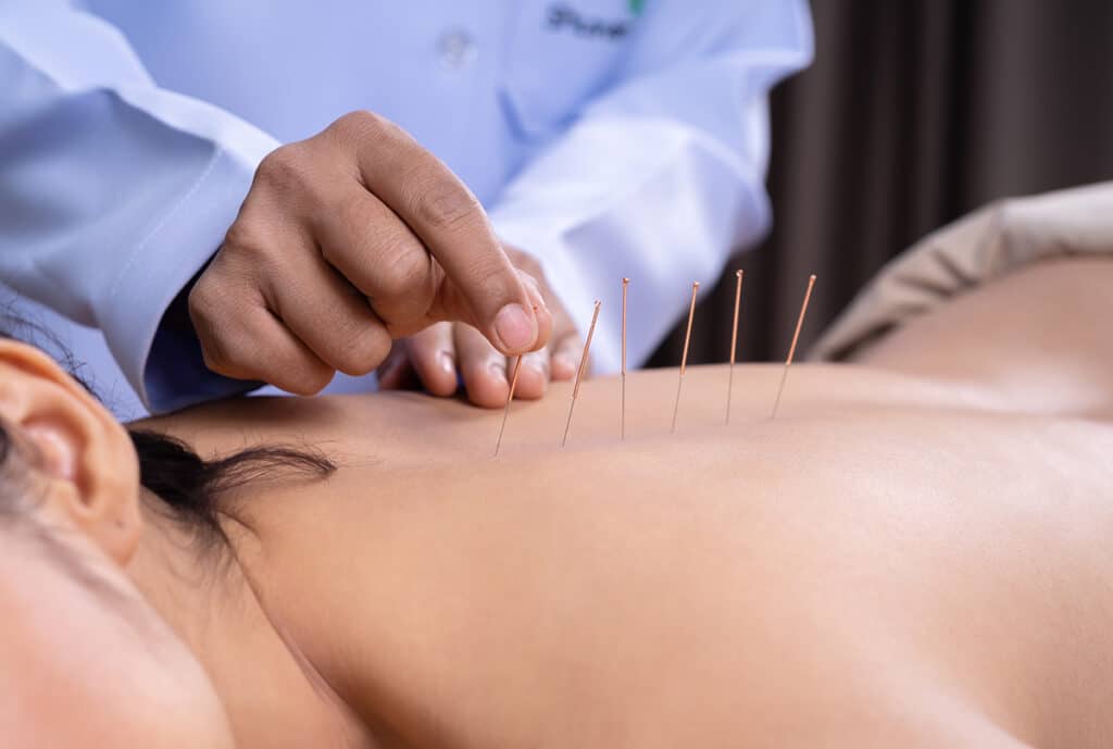 acupuncture for young adults