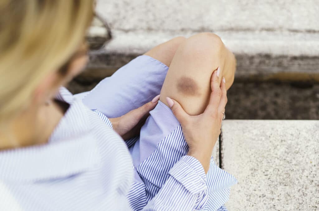 What is the Quickest Way to Get Rid of Contusions?