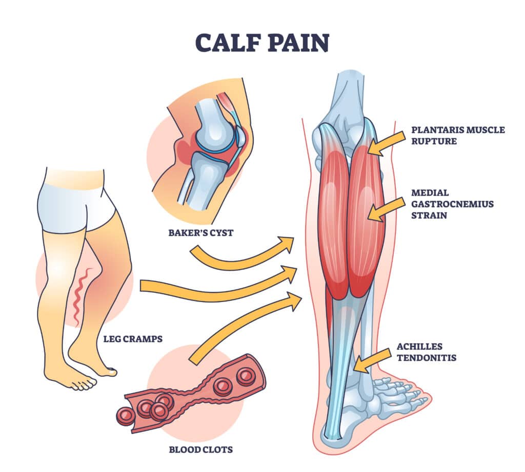 anatomy image of calf pain and strain