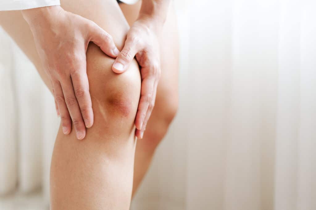 Do Contusions Heal Naturally?