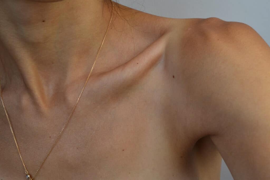 Why is Thoracic Outlet Syndrome So Hard to Heal?