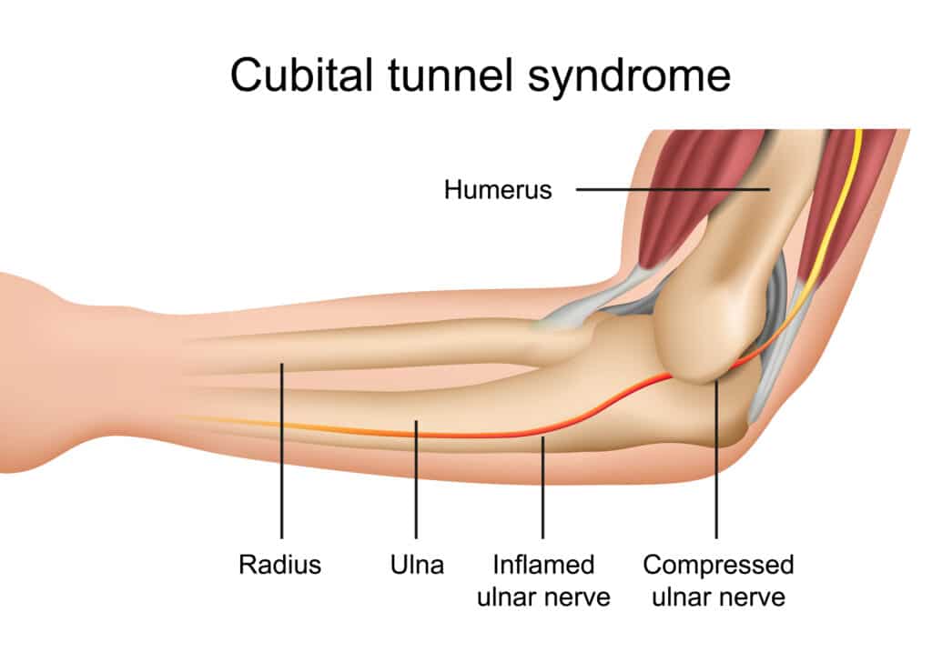 Cubital tunnel syndrome anatomy