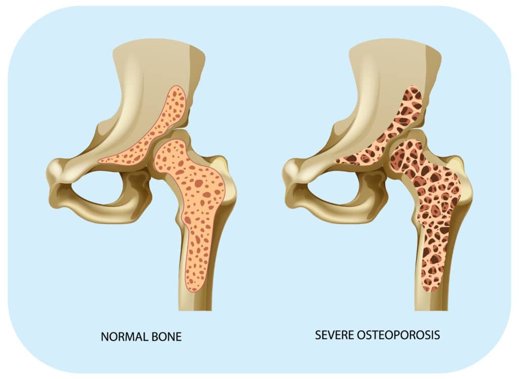 Osteoporosis Anatomy