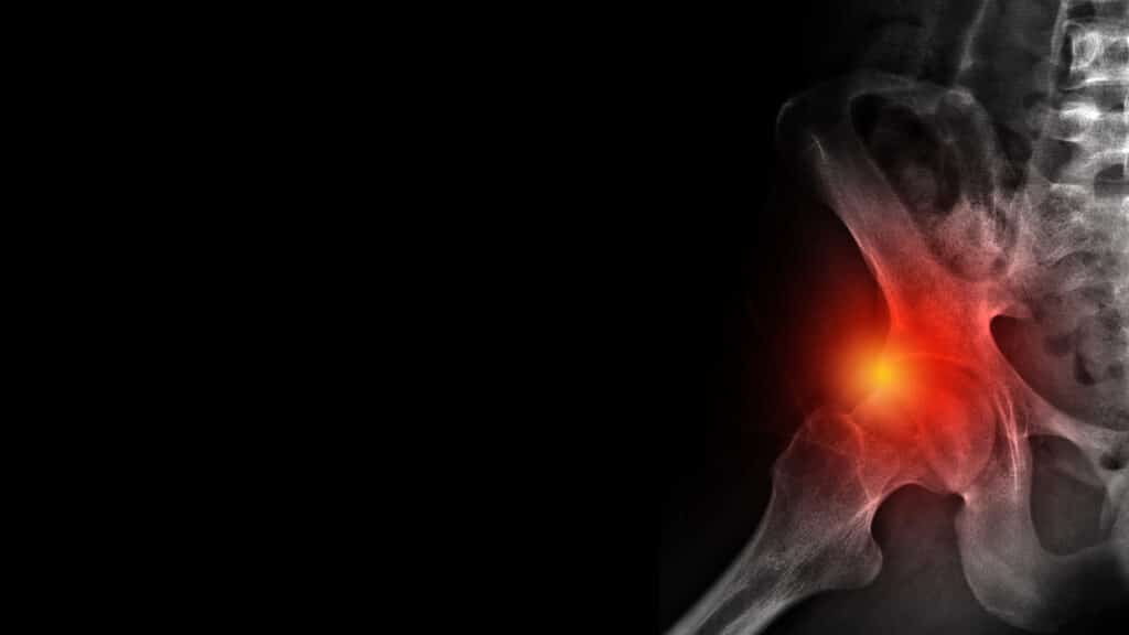 Femoroacetabular Impingement Anatomy