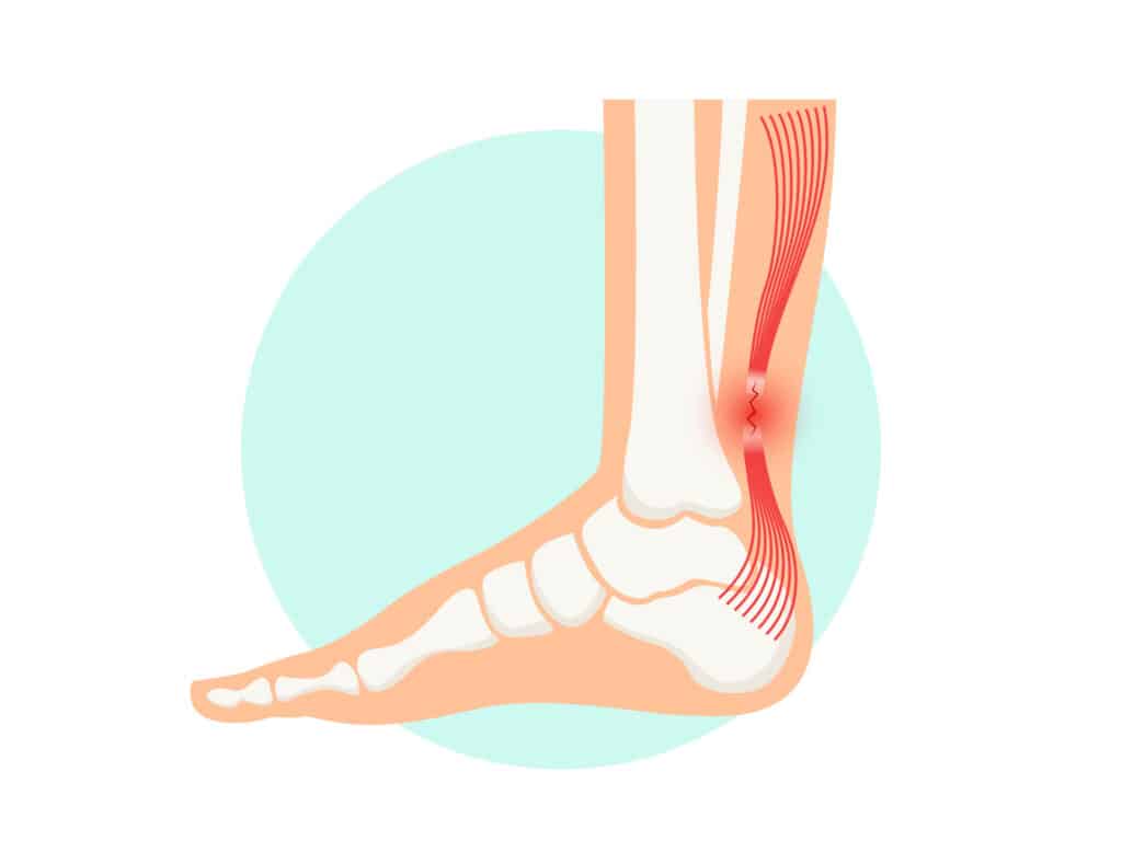 Achilles Tear Anatomy