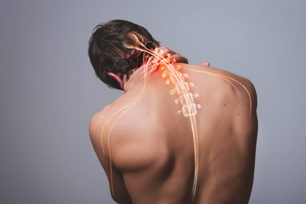 Cervical Radiculopathy Anatomy