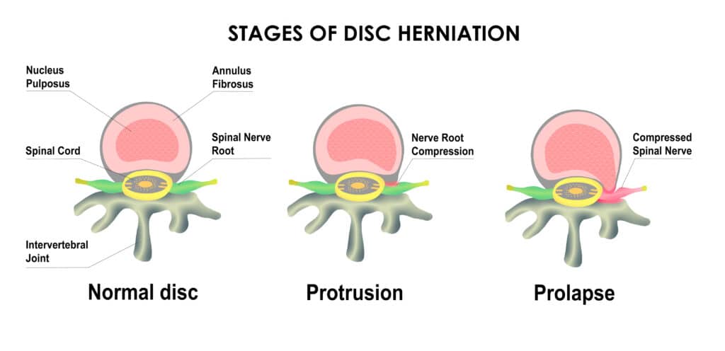 Cervical Disc Herniation Anatomy