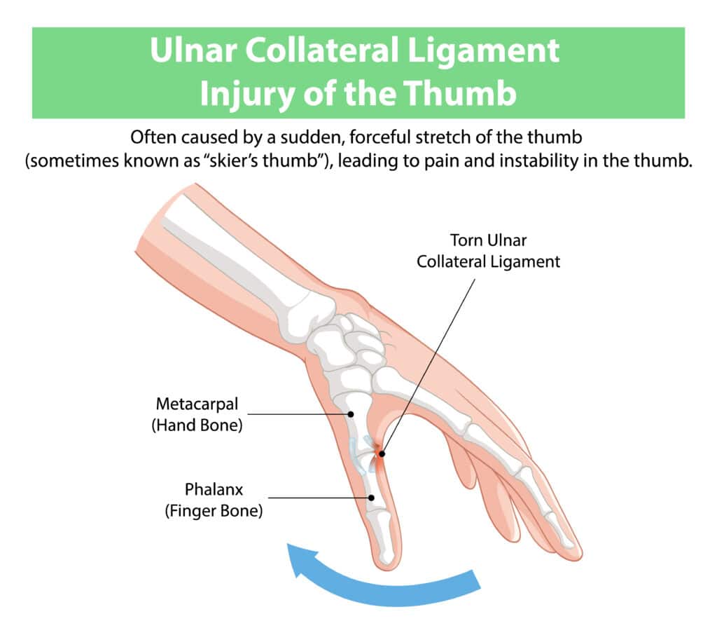 Thumb UCL Sprain Anatomy