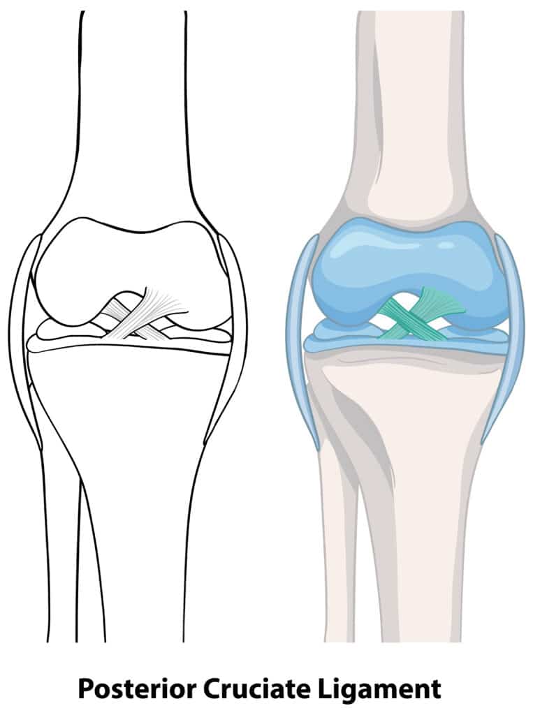 PCL Tear Anatomy