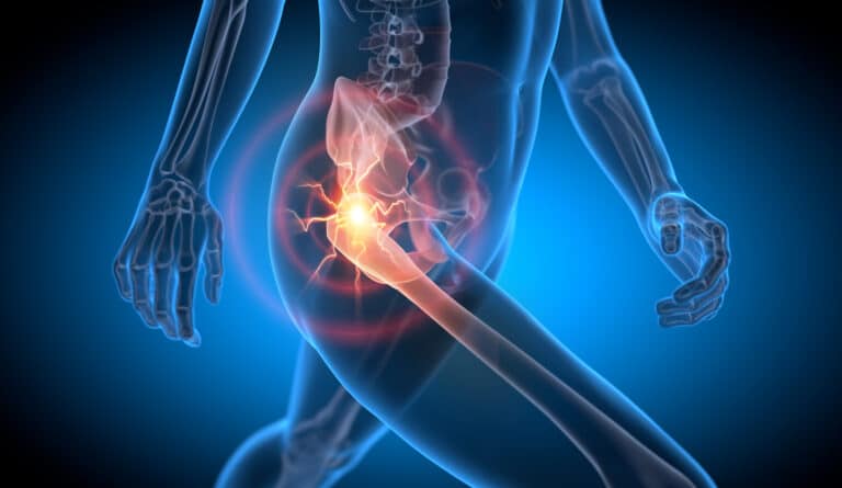 Greater Trochanteric Pain Syndrome (GTPS) – Recovery, Tre...