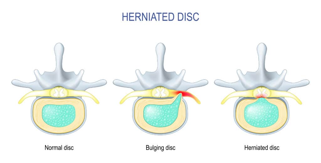 Herniated disc anatomy