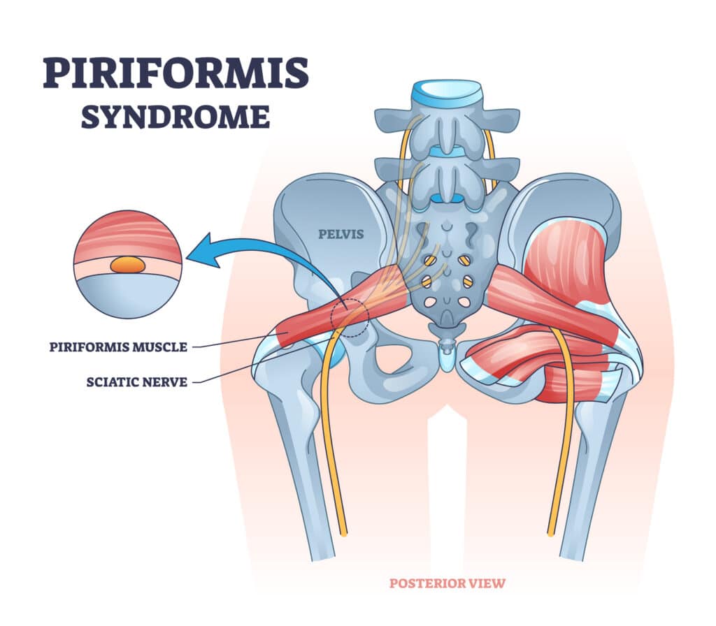 Piriformis/Deep Gluteal Syndrome