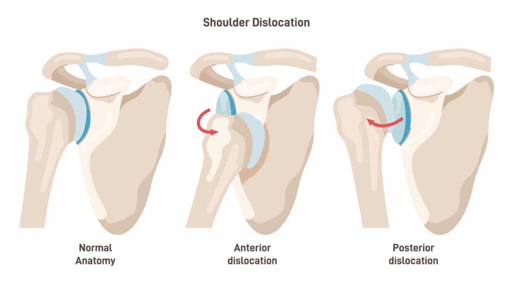 Dislocation anatomy