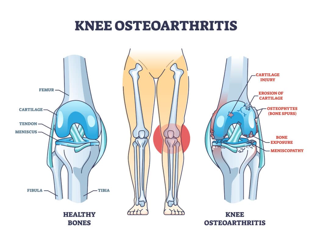 Knee osteoarthritis anatomy