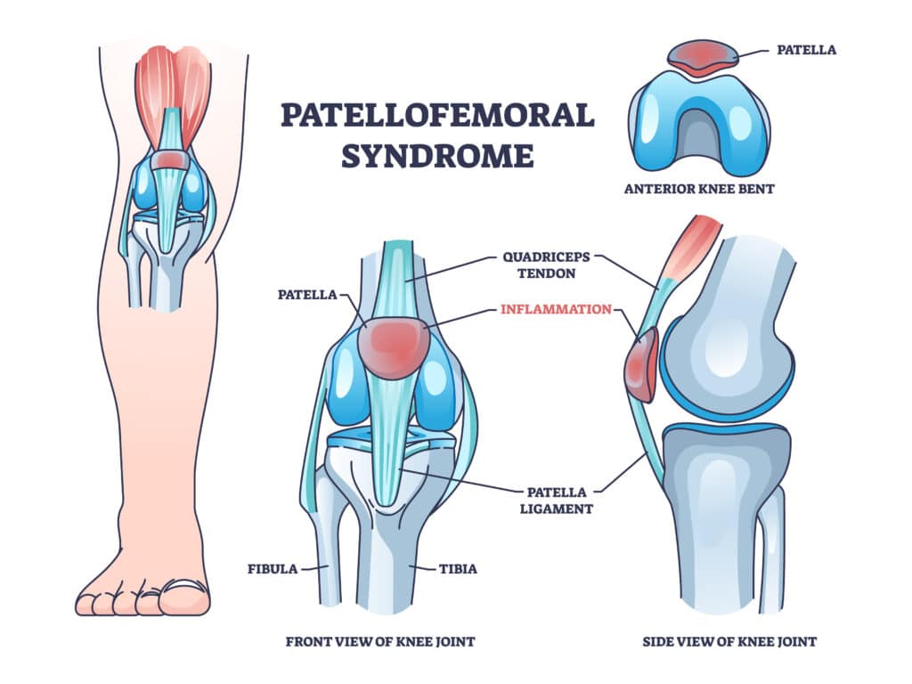 Patellofemoral pain syndrome anatomy