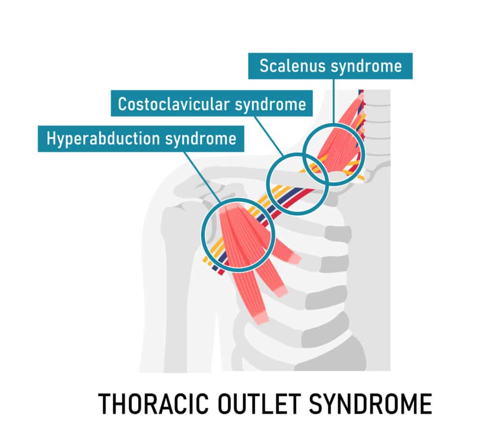 Thoracic Outlet Syndrome Anatomy