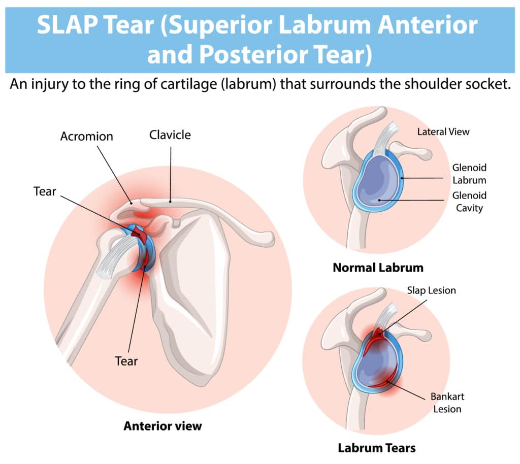 Shoulder SLAP Lesion Anatomy