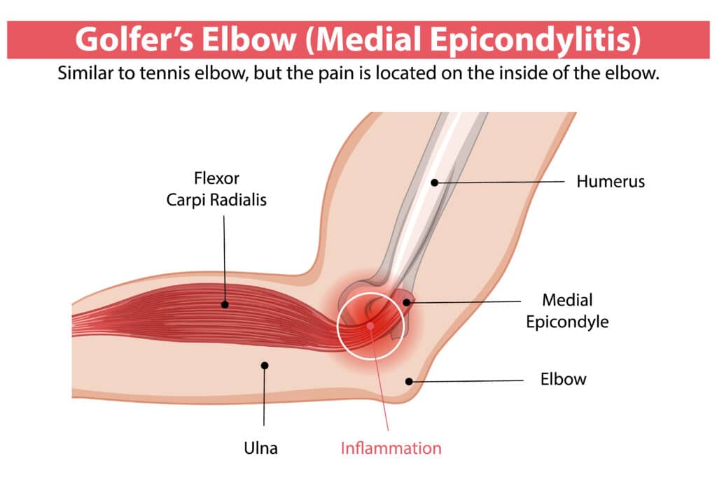Golfers elbow anatomy