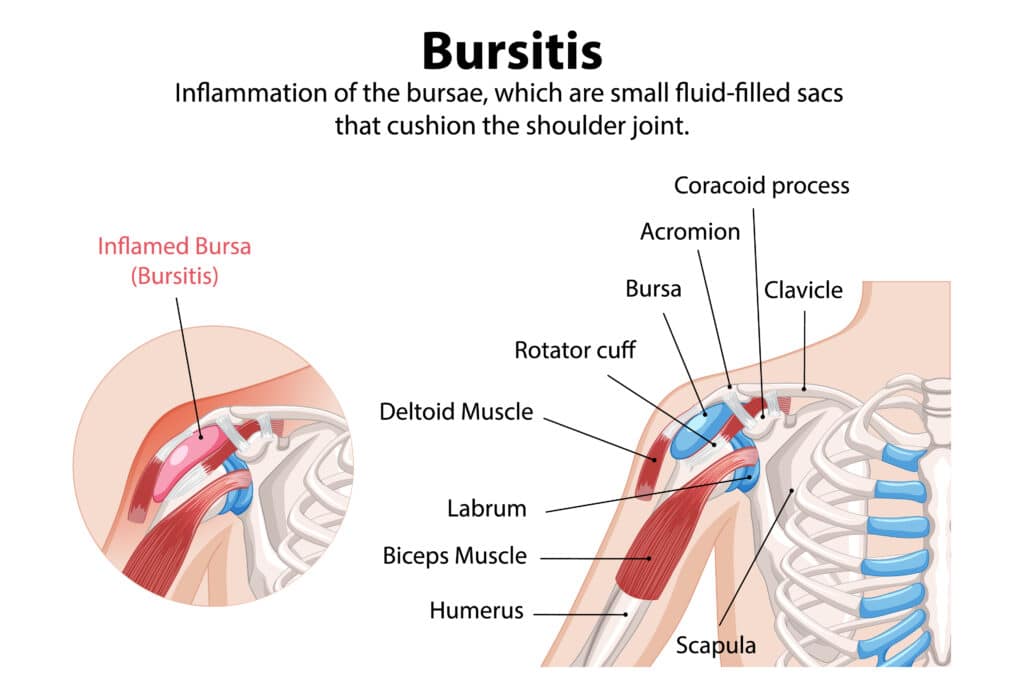 Shoulder bursitis anatomy