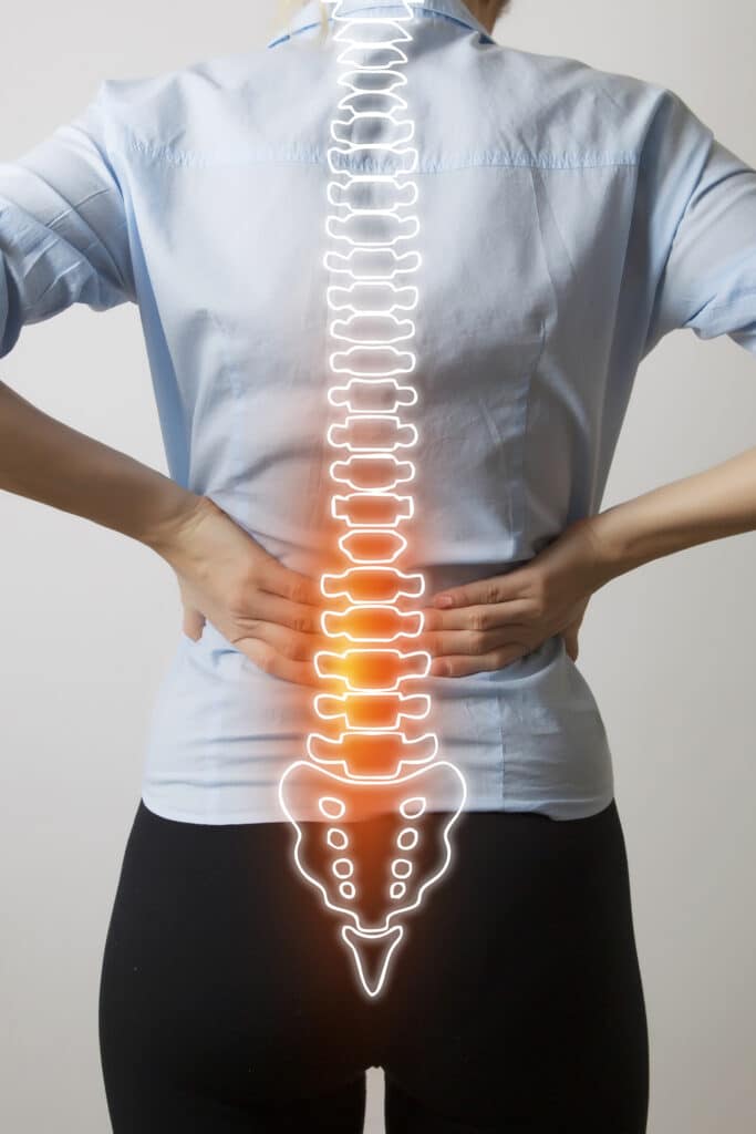 Lumbar Radiculopathy Anatomy