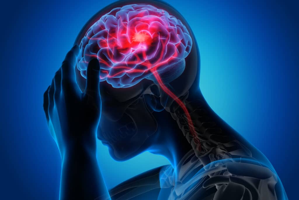 Migraines and Headaches Anatomy