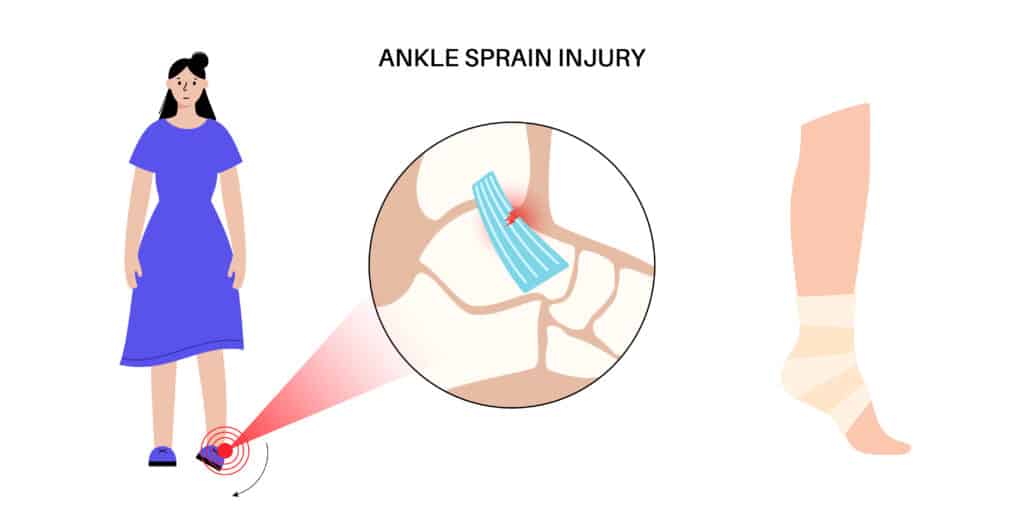 Lateral Ankle Sprain Anatomy