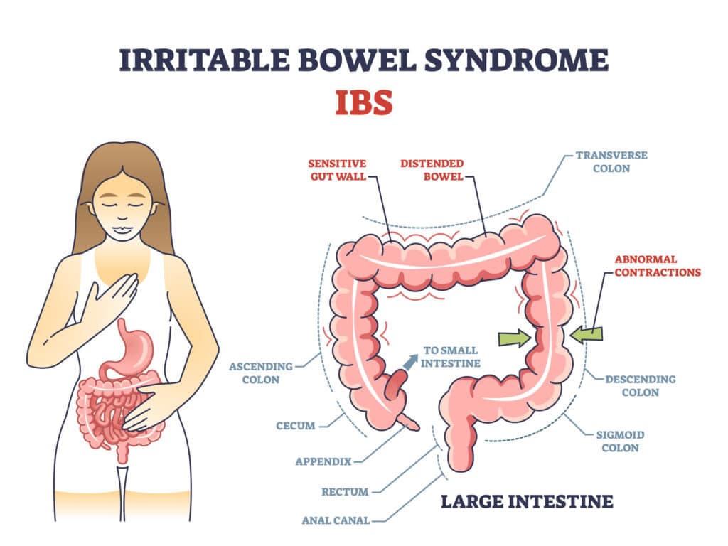 Irritable Bowel Syndrome Anatomy