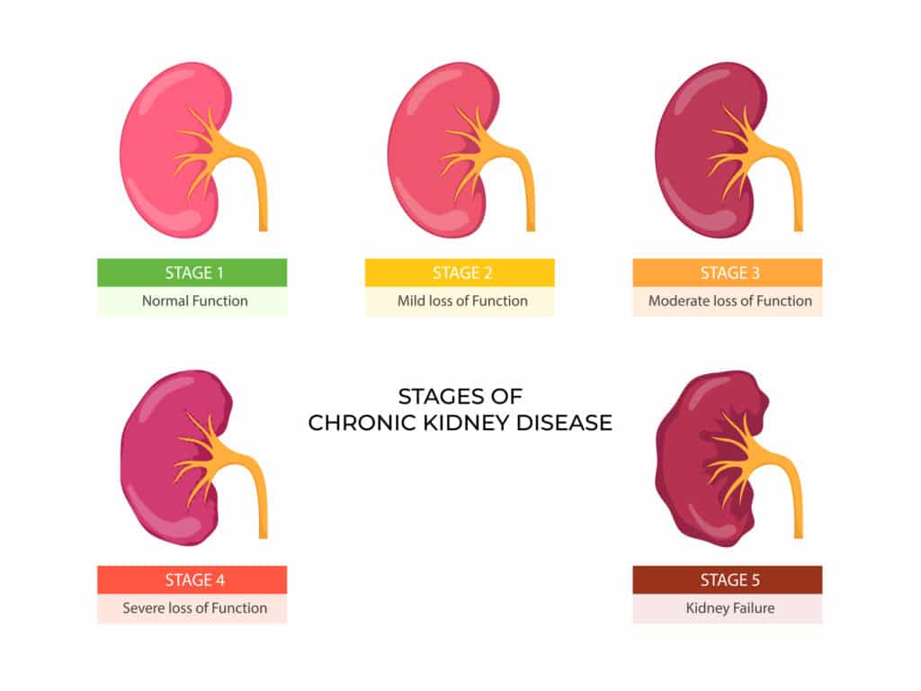 Chronic Kidney Disease Anatomy