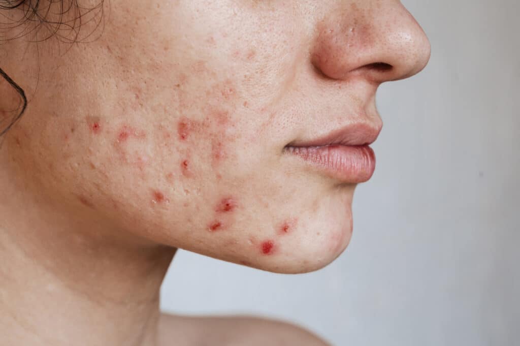 Acne Anatomy