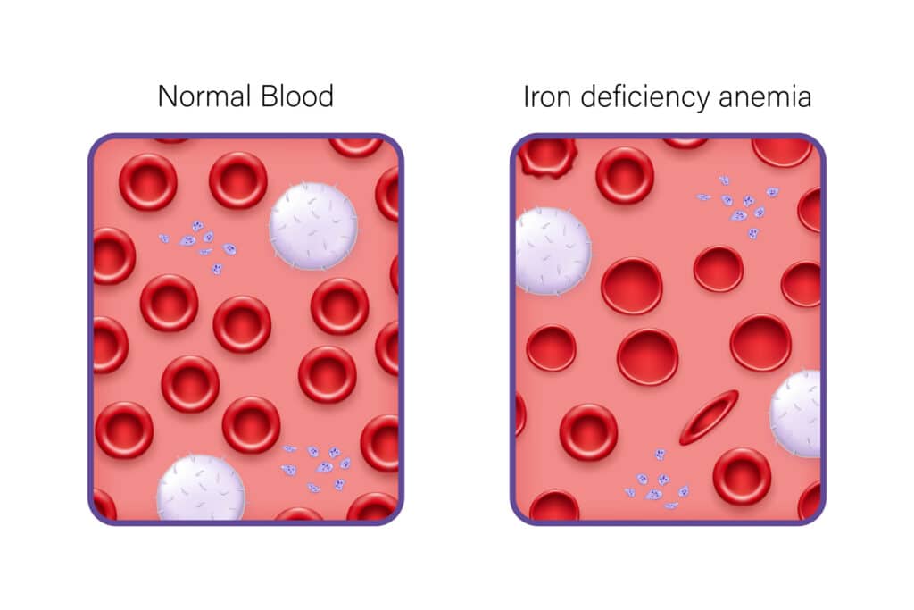 Iron Deficiency Anemia Anatomy