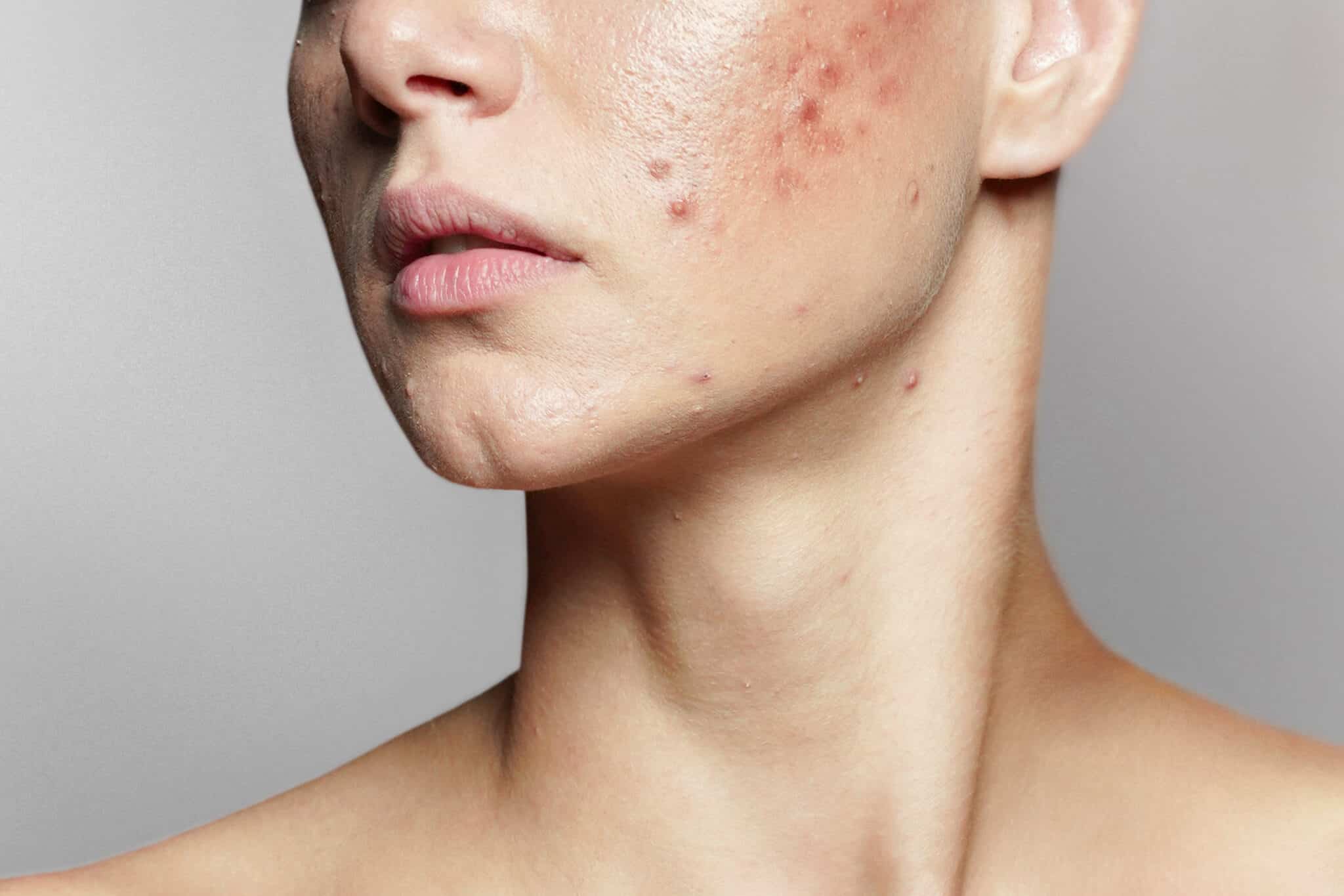 Can a Dietitian Help with Acne?