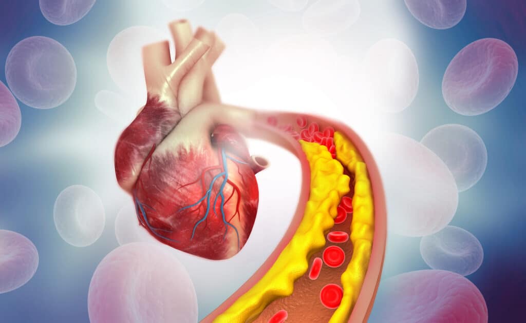 High Cholesterol Anatomy